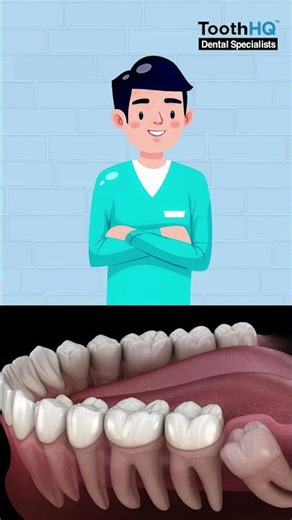 Why Mini-Implants for overbite?