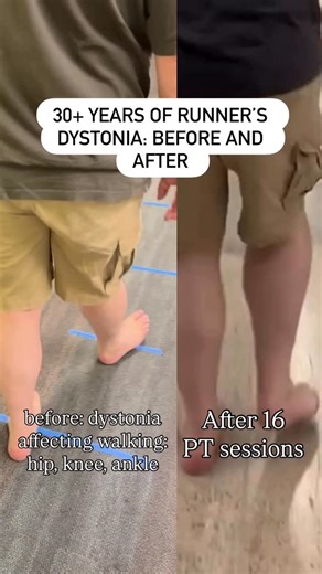 Dr. Julie Hershberg on Instagram: "30+ years of runner’s + walking dystonia—and look at this progress! 🏃‍♂️👏 just 16 sessions of PT, focusing on sensory and motor control training to reconnect the brain + body. Here’s what we worked on: ➡️ Joint position training with tilt boards + sensory inputs ➡️ Sensory-assisted walking with therabands + scarves ➡️ Sled pushes with weighted sandbags for step path awareness ➡️ Targeted sensory cues to retrain gait patterns The result? A stronger, more conne