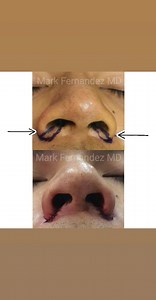 9K views · 113 reactions | Alar trimming is part of the noselift procedure that narrows the width of the nose. It will improve the contour and definition of your nasal alar lobule area. It will also narrow the span of nostrils and alar base, giving a more proportioned shape to your nose. Here is an immediate result. -MF | Mark Fernandez MD | Facebook