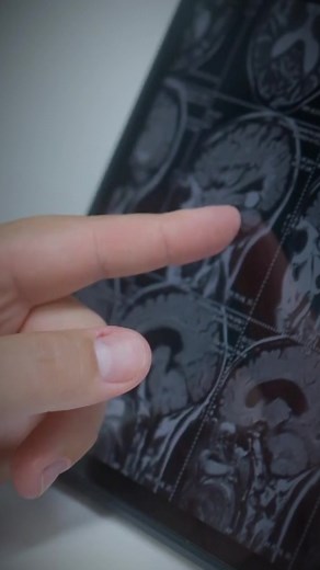 4K views · 12 reactions | Today, InvestigateTV+ meets several P.A.N.D.A.S. families. Learn the signs of this condition today at 4:30 on KEYC CBS. | KEYC News Now | Facebook