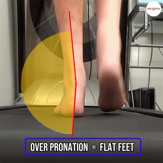 1.2K views | Overpronation is common in people with flat feet, where...