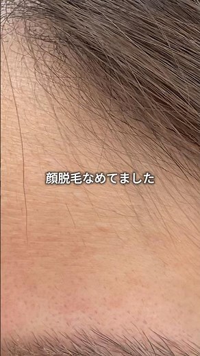 顔脱毛なめてた‼️まじ全人類はやく始めた方がいい。小鼻も眉間も超細かく照射してくれるルシアが個人的にはおすすめ‼️3万円ｵﾌはコメント欄に #医療脱毛 #顔脱毛 #垢抜け #美肌 #水光肌 #ツヤ肌