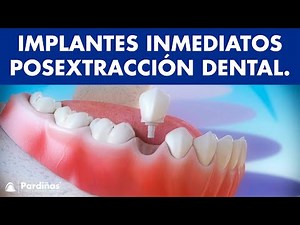 Implantes dentales inmediatos posextracción dental ©