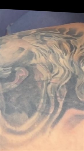 Embarking on the Journey of Tattoo Removal