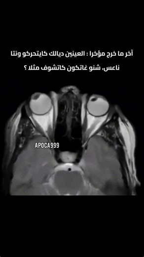 فمرحلة النوم حركة العين كاتكون سريعة (REM)، حيت كيكون الدماغ خدام بأقصى طاقتو، مع أن الجسم كيكون شبه مشلول. العينين كيتحركو حيث الدماغ كيعالج صور ومشاهد حقيقية داخل الحلم، بحال إلا كنتي كتشوف بعينيك وانتِ فايق. هاد الفيديو كيبرّز نشاط دماغ الإنسان وهو ناعس، فين كيتنشطو مراكز الذاكرة والخيال والمشاعر، وكيكون الجسم مفصول مؤقتاً على الوعي… وكيبدأ العقل الرحلة ديالو بوحدو. المصادر: دراسات من ScienceDaily و Sci.News كتشير باللي حركة العين السريعة أثناء النوم ممكن تعكس شنو كنشوفو داخل الحلم، وكأن العي