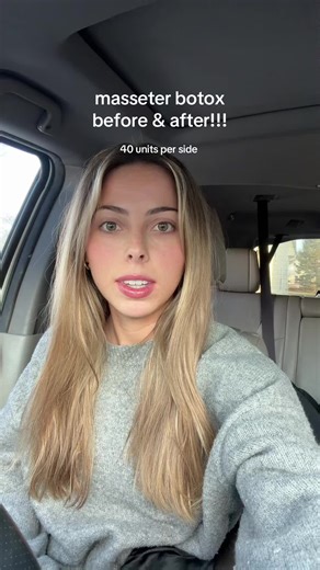 Masseter Botox: Transform Your Jawline Before & After