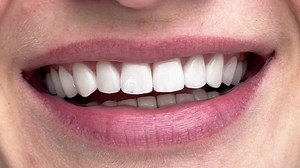 Perfect White Teeth Close Female Crown Stock Footage Video (100% Royalty-free) 1089005243 | Shutterstock