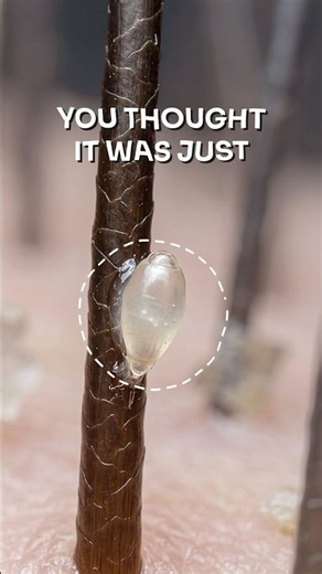 How to Remove LICE from Hair…