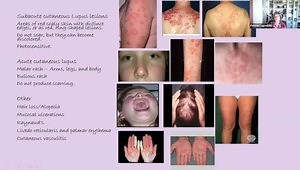 What is Lupus and How Do We Treat It?