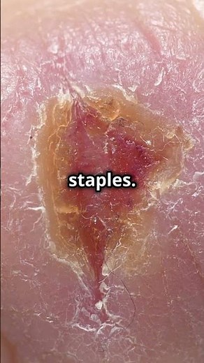 How Skin Grafting Works