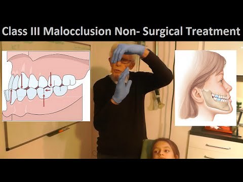 Correcting Class III Malocclusion without Tooth Extraction or Oral Surgery by Prof John Mew
