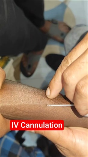 IV Cannulation Technique Procedure