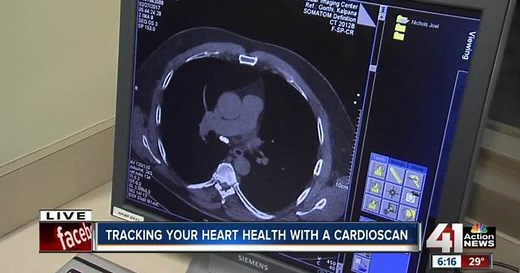 St. Luke's offers $50 CardioScan for your heart