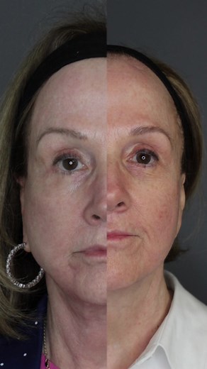 Halo Laser: Revitalize Your Skin Non-Surgically