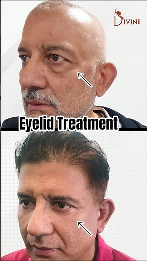 Blepharoplasty Surgery Before and After | Lower Blepharoplasty (Eyelid Surgery) Result