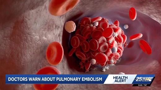 What to know about pulmonary embolism, including risks and prevention