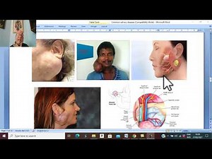 Head and neck surgery in Arabic 10 ( Pleomorphic adenoma) , by Dr. Wahdan