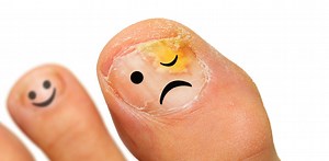Fighting fungal nail infections: simple steps for healthier toenails
