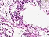 Metastatic calcification - Histopathology - Lung, kidney • Video • MEDtube.net