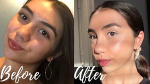 Fungal Acne Clearing Skincare Routine - How To Clear Fungal Acne