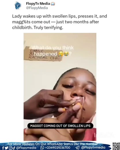Flopymedia Blog Entertainment on Instagram: "A lady has shared a disturbing experience of waking up with swollen lips, only to press it and find magg%ts coming out — a shocking incident that happened just two months after she gave birth."