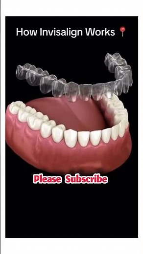 How invisalign works