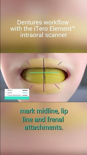 Capture bite with a putty matrix | iTero™ intraoral scanner