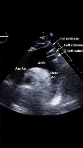Supra sternal notch view#aorta #echocardiography