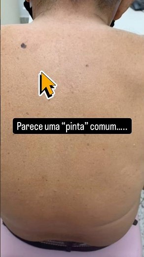 O MELANOMA PODE PARECER UMA PINTA COMUM. #cancerdepele #melanoma #dermatoscopia
