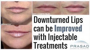 Treatment Options to Correct a Permanent Frown