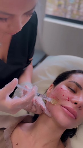 Skin Booster Treatment This treatment works from the inside out, helping to rebuild collagen and elastin and restore a radiant glow to your complexion, allowing you to achieve firmer, more youthful-looking skin. @leblanccosmetics_ @aestheticsbyjoz