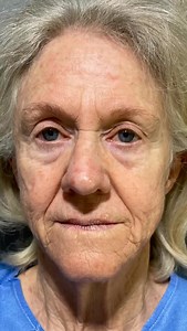 ✨ El cambio habla por sí solo… ✨ Mini Face Lift = Resultados visibles, cicatriz casi invisible 💎 Un antes y después que rejuvenece sin perder tu esencia. 📲 ¿Lista para tu transformación? Agenda tu valoración hoy mismo. #MiniFaceLift #AntesYDespues #GlowUp2025 #RejuvenecimientoFacial #BellezaNatural #TransformacionReal #CirugiaEstetica #TrendingBeauty #ViralNow #skingoals | DR Victor Verdugo