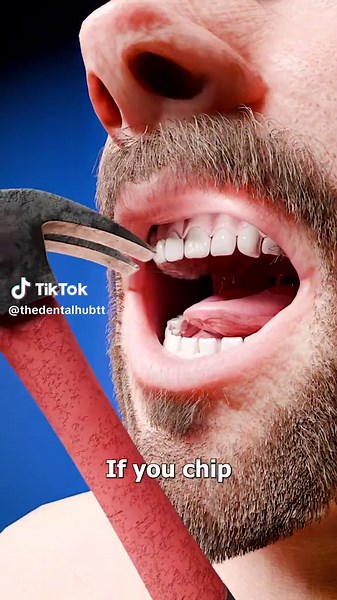 Chipped Tooth Repair Process Explained by Dentist