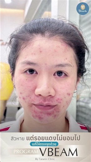 โปรแกรม Vbeam perfectra ดูแลสิวอักเสบ และรอยแดงสิว