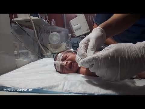 Safe NG Tube Placement and Secretion Removal in Newborns