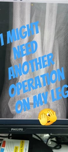 Might need another operation on the rod in my leg #bruno #operation #shorts #share #tibia #short