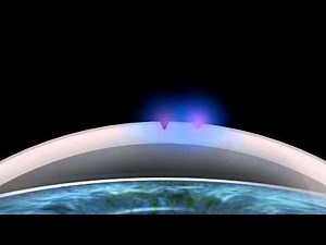 TransPRK: „No-Touch" Surface Treatment with SCHWIND AMARIS Laser Systems