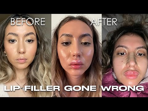 MY FIRST LIP FILLER EXPERIENCE! Juvederm Ultra 3 before & after | 2 months update with pictures