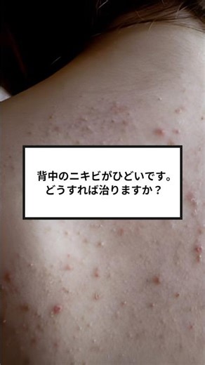 Things to be careful of in your daily life to cure back acne #back #acne