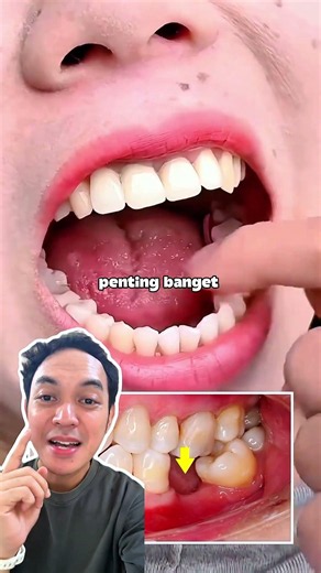 Pakai gigi tiruan / gigi palsu itu penting banget untuk mencegah pergerakan gigi lainya