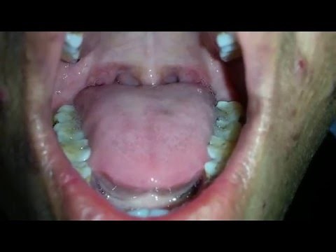 Tongue Fasciculation in MND
