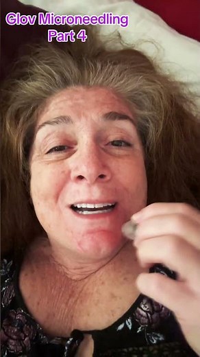 All right guys this is part four of the GLOV micro needling demonstration