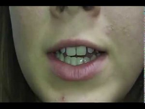 Vanessa's Labiaplasty Surgery Experience with Dr D at OcBody.com