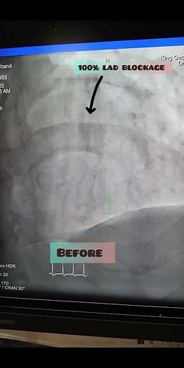 Cardiac Emergency:100% LAD blockage after angioplasty-A medical insight