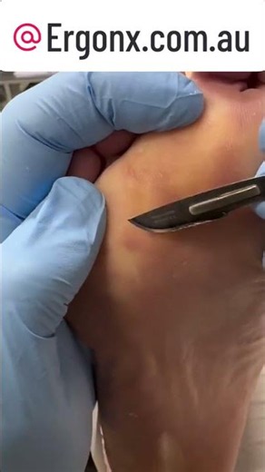 Ultimate Callus Removal from Scar in Podiatry Clinic #Podiatry #FootCare
