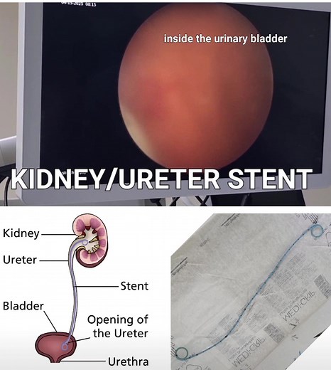 Kidney and Ureter Stent Removal Procedure Explained