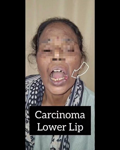 Carcinoma of the Lower Lip | Dr. Deepak Rathore | A Female Patient Testimonial