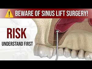 7 Hidden Risks of Sinus Lift Your Dentist Won’t Tell You