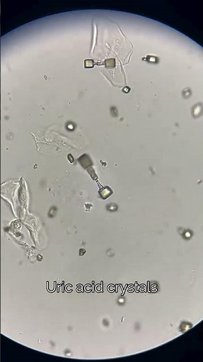Uric Acid Crystal Formation Explained! 🧪