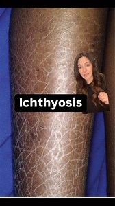 4.4K views · 111 reactions | Ichthyosis is a condition where the skin looks like fish scales. It’s very common, worse in winter and can be associated with eczema. #dermatology #skincare #ichthyosis #eczema #skincaretips #dryskin #skintips | Dr. Jessica Burgy | Facebook